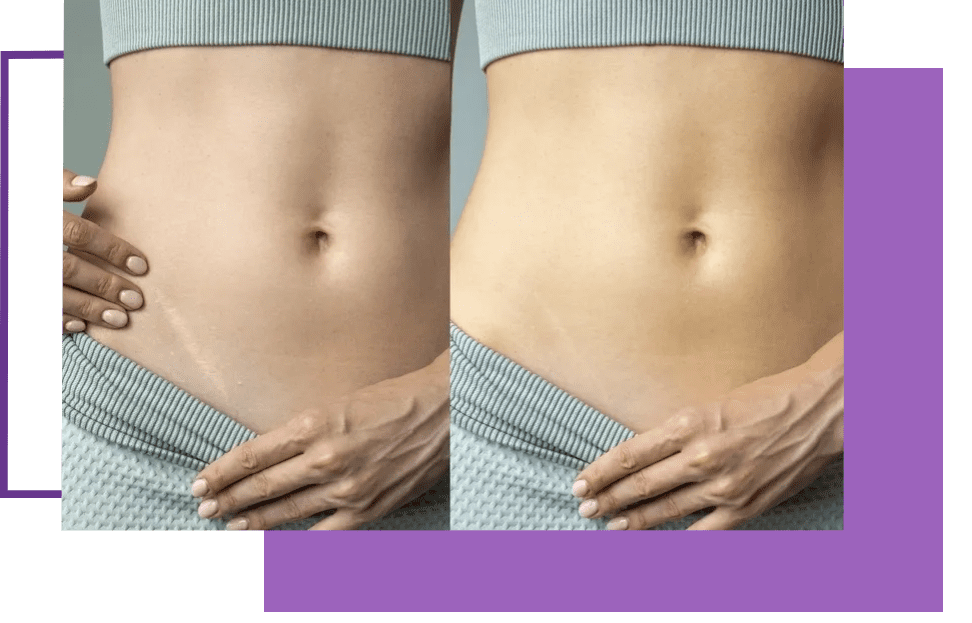 A woman 's stomach before and after her weight loss.